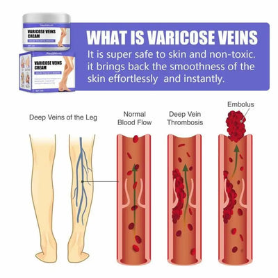 Varicose Vein Treatments Cream Effective Relieve Legs Dilated Vasculitis Phlebitis Natural Formula Ointment for Varicose Veins