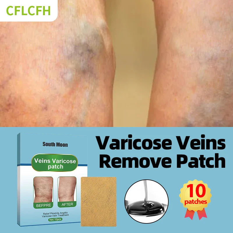 Varicose Veins Relief Patch Foot Care Vasculitis Phlebitis Treatment Cream Spider Leg Varicosity Angiitis Legs Dilated Medicine