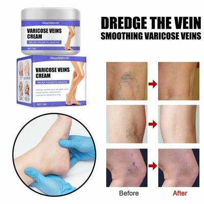 Varicose Vein Treatments Cream Effective Relieve Legs Dilated Vasculitis Phlebitis Natural Formula Ointment for Varicose Veins