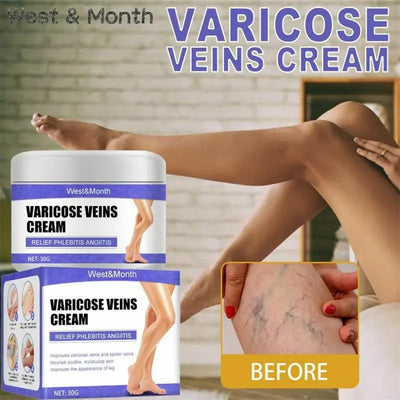 Varicose Vein Treatments Cream Effective Relieve Legs Dilated Vasculitis Phlebitis Natural Formula Ointment for Varicose Veins